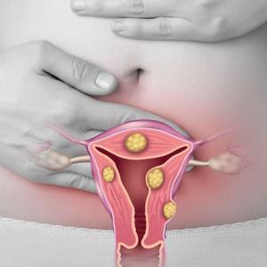 what-are-fibroids